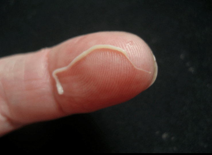 الدودة الطفيلية في جسم الإنسان